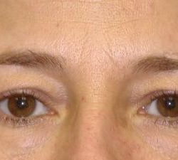 Blepharoplasty Before & After Patient #2535