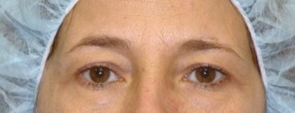Blepharoplasty Before & After Patient #2535