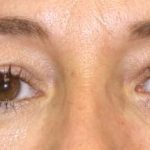 Blepharoplasty Before & After Patient #2535