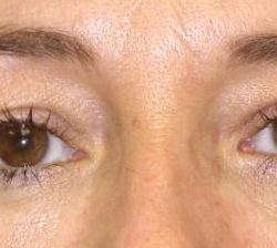 Blepharoplasty Before & After Patient #2535