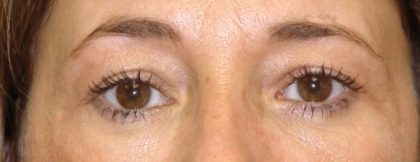 Blepharoplasty Before & After Patient #2535