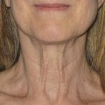 Ultherapy Before & After Patient #2707