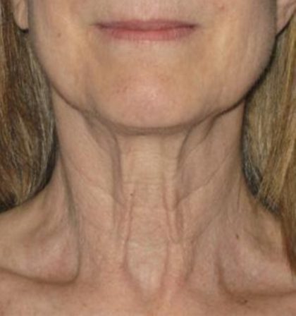Ultherapy Before & After Patient #2707
