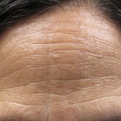 Botox Before & After Patient #2579