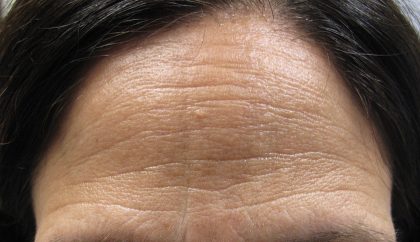 Botox Before & After Patient #2579