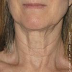 Ultherapy Before & After Patient #2707