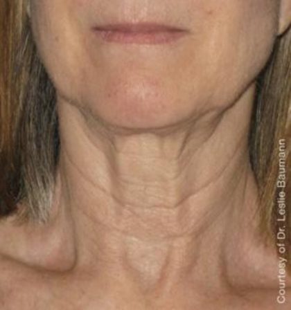 Ultherapy Before & After Patient #2707