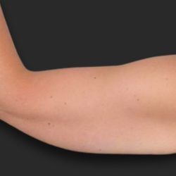 Brachioplasty (Arm Lift) Before & After Patient #2517