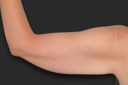 Brachioplasty (Arm Lift) Before & After Patient #2517