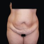 Tummy Tuck Before & After Patient #2501