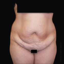 Tummy Tuck Before & After Patient #2501