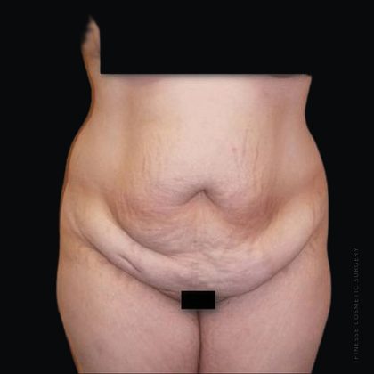 Tummy Tuck Before & After Patient #2501
