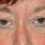 Blepharoplasty Before & After Patient #2526