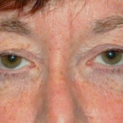 Blepharoplasty Before & After Patient #2526