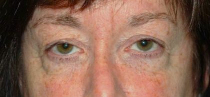 Blepharoplasty Before & After Patient #2526