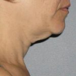 Ultherapy Before & After Patient #2708