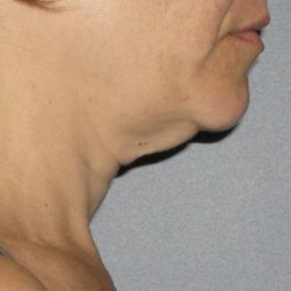 Ultherapy Before & After Patient #2708