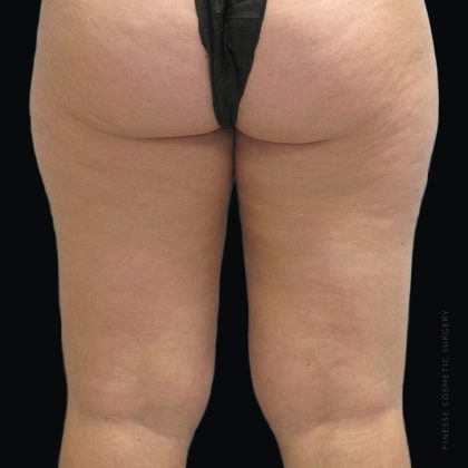 Smartlipo Vaser Lipo Before & After Patient #2868