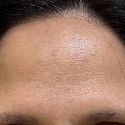 Botox Before & After Patient #2579