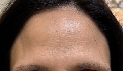Botox Before & After Patient #2579