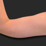 Brachioplasty (Arm Lift) Before & After Patient #2517