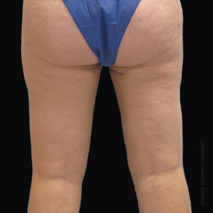Smartlipo Vaser Lipo Before & After Patient #2868