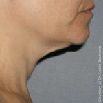 Ultherapy Before & After Patient #2708