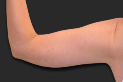 Brachioplasty (Arm Lift) Before & After Patient #2517