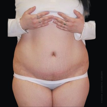 Tummy Tuck Before & After Patient #2501