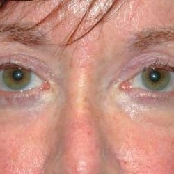 Blepharoplasty Before & After Patient #2526