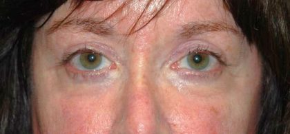 Blepharoplasty Before & After Patient #2526