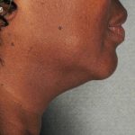 Ultherapy Before & After Patient #2709