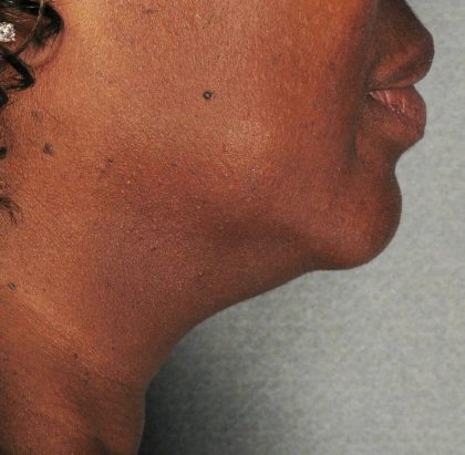 Ultherapy Before & After Patient #2709