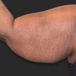 Brachioplasty (Arm Lift) Before & After Patient #2518