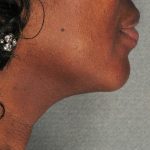Ultherapy Before & After Patient #2709
