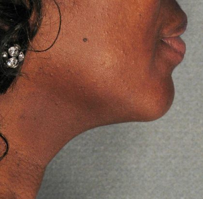 Ultherapy Before & After Patient #2709