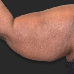Brachioplasty (Arm Lift) Before & After Patient #2518