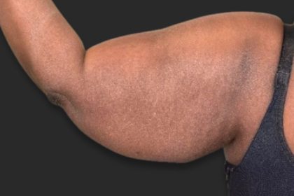Brachioplasty (Arm Lift) Before & After Patient #2518
