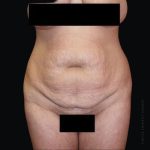 Tummy Tuck Before & After Patient #2502