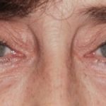 Blepharoplasty Before & After Patient #2527