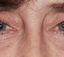 Blepharoplasty Before & After Patient #2527
