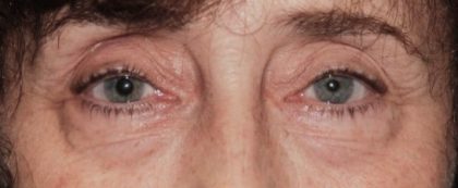 Blepharoplasty Before & After Patient #2527