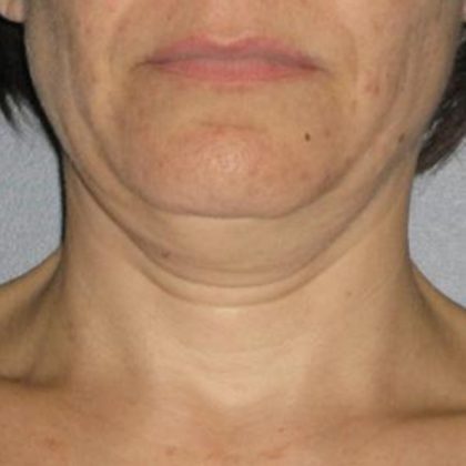 Ultherapy Before & After Patient #2710