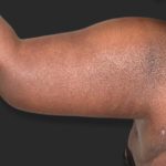Brachioplasty (Arm Lift) Before & After Patient #2518