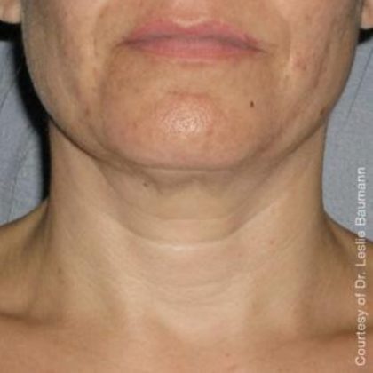 Ultherapy Before & After Patient #2710