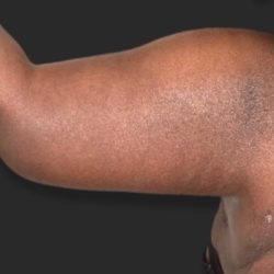 Brachioplasty (Arm Lift) Before & After Patient #2518