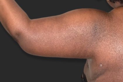 Brachioplasty (Arm Lift) Before & After Patient #2518