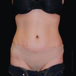 Tummy Tuck Before & After Patient #2502