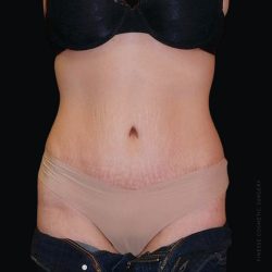 Tummy Tuck Before & After Patient #2502