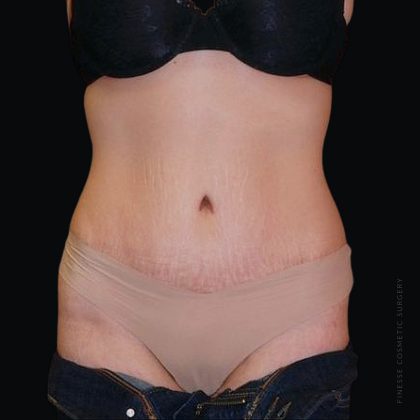Tummy Tuck Before & After Patient #2502
